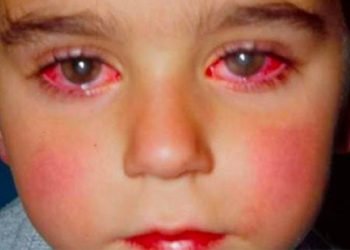 ბიჭმა მხედველობის 75% დაკარგა იმ სათამაშოს გამო, რომელიც ბავშვების უმრავლესობას აქვს! ეს აუცილებლად ყველა მშობელმა უნდა იცოდეს