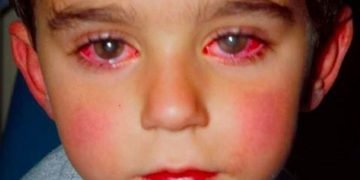 ბიჭმა მხედველობის 75% დაკარგა იმ სათამაშოს გამო, რომელიც ბავშვების უმრავლესობას აქვს! ეს აუცილებლად ყველა მშობელმა უნდა იცოდეს