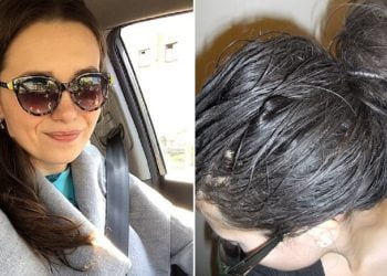 ტილები დამესივნენ და თავი გადავიპარსე, სანამ სახლში არავინ იყო ისეთი რაღაც გავაკეთე ეგრევე კანის წვა დამეწყო, ექიმთან გამაქანეს მაგრამ რა ვიცოდი იქ უარესი რომ მელოდებოდა