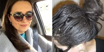 ტილები დამესივნენ და თავი გადავიპარსე, სანამ სახლში არავინ იყო ისეთი რაღაც გავაკეთე ეგრევე კანის წვა დამეწყო, ექიმთან გამაქანეს მაგრამ რა ვიცოდი იქ უარესი რომ მელოდებოდა