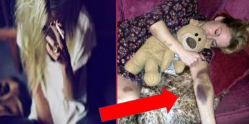 წვეულებიდან მოსული გოგონა თავს ჩვეულებრივად გრძნობდა და დაიძინა.. თუმცა დილით მსგავსი ლაქებით დაიღვიძა და ის რამაც მის სხეულზე მსგავსი სილურჯეები წარმოქმნა გამაოგნებელია..