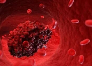 8 ნიშანი იმისა, რომ სისხლძარღვებში საშიში თრომბი გაქვთ