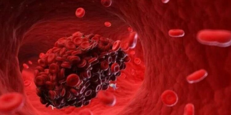 8 ნიშანი იმისა, რომ სისხლძარღვებში საშიში თრომბი გაქვთ