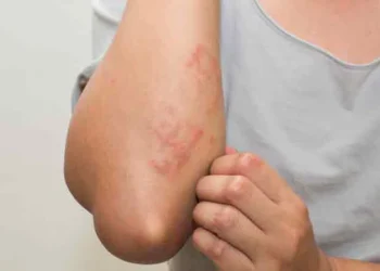 ,,უკვე მე-4 შემთხვევა დაფიქსრდა“ – ვრცელდება საგანგაშო ინფორმაცია – რომელ სკოლაში ვლინდება მუნის შემთხვევები?