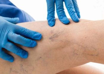 მთავარი ნიშნები, რომ სისხლძარღვებში საშიში თრომბი გაქვთ