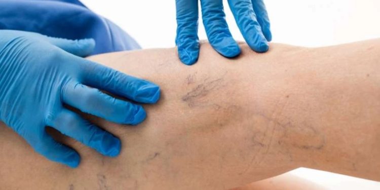 მთავარი ნიშნები, რომ სისხლძარღვებში საშიში თრომბი გაქვთ